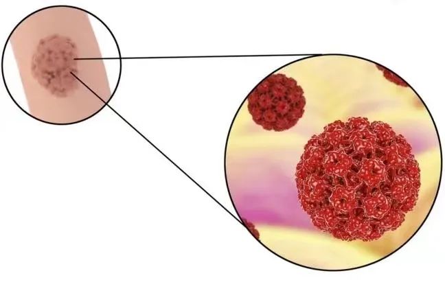 身上五种小疙瘩可能与HPV感染有关联