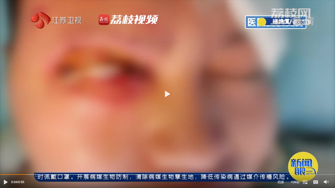 暖宝宝爆炸灼伤事件引发警示与反思，男孩眼角膜受损